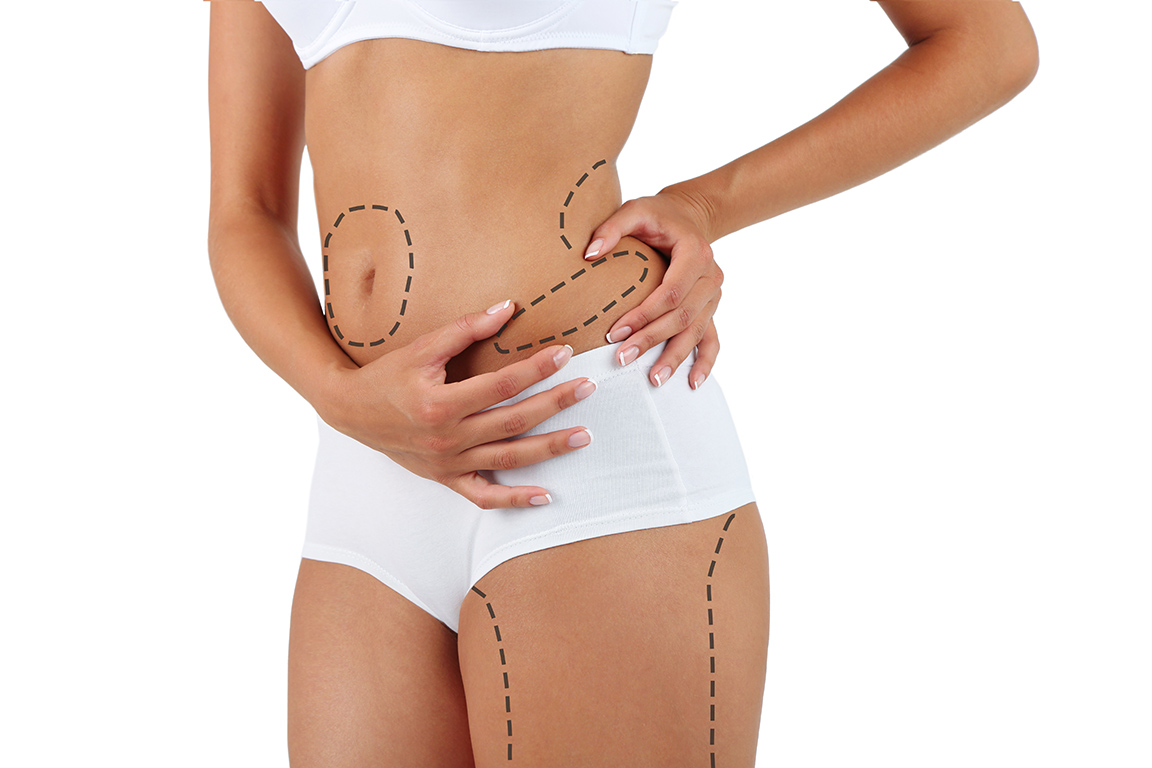 Liposuction